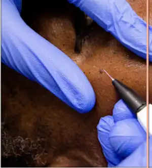 Close-up of a professional microneedling treatment